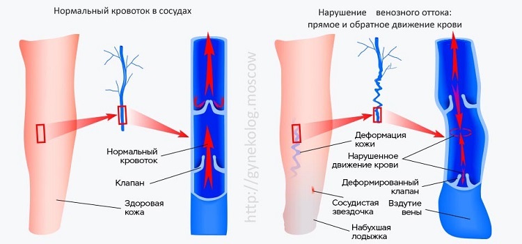 Варикозное Расширение Вен На Ногах Симптомы И Лечение Лекарства