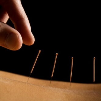 Иглоукалывание при бесплодии: врут ли отзывы, эффекты от метода