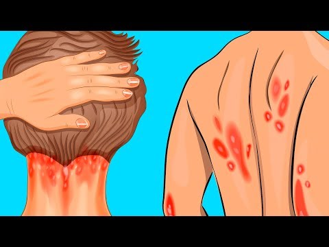 Может ли псориаз быть причиной бесплодия: диагностика и лечение, народные средства, расшифровка, таблица