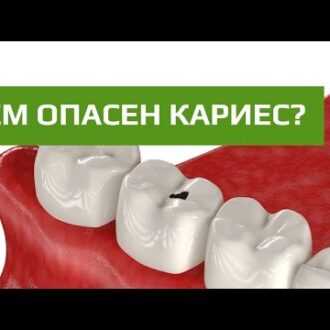 Кариес зубов: как лечить, какой бывает, причины возникновения, профилактика