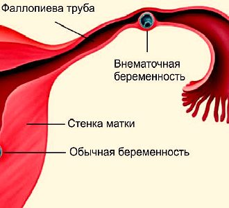 Форма мужского бесплодия — азооспермия? лечение, отзывы у мужчин