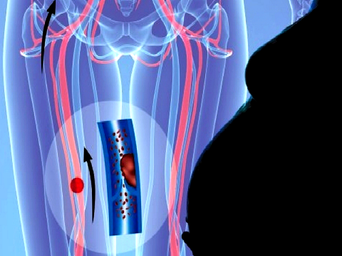 Д-димер при беременности: сроки выполнения анализа и расшифровка