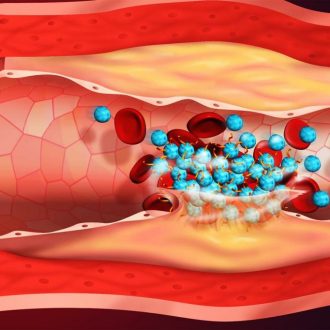Как не допустить тромбоз после коронавируса