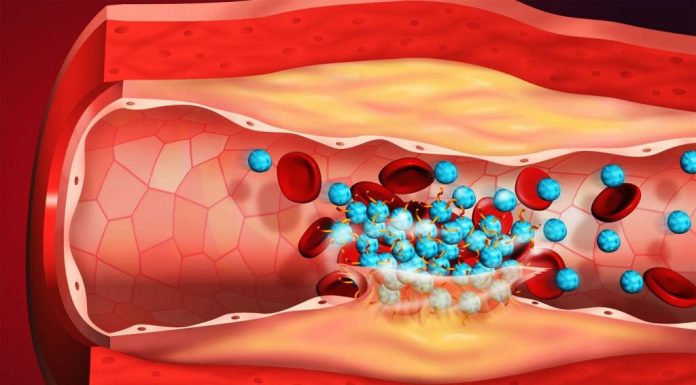 Как не допустить тромбоз после коронавируса