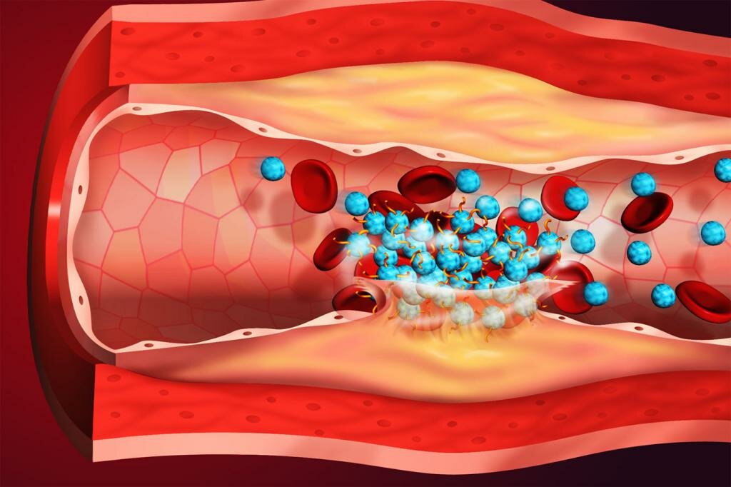 Как не допустить тромбоз после коронавируса