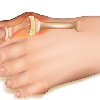 Известный патогенез заболевания подагры и процедура лечения