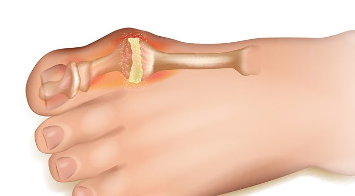 Известный патогенез заболевания подагры и процедура лечения