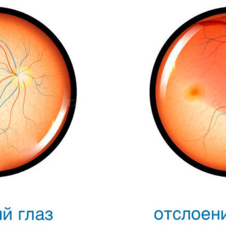 Причины отслоения сетчатки глаза