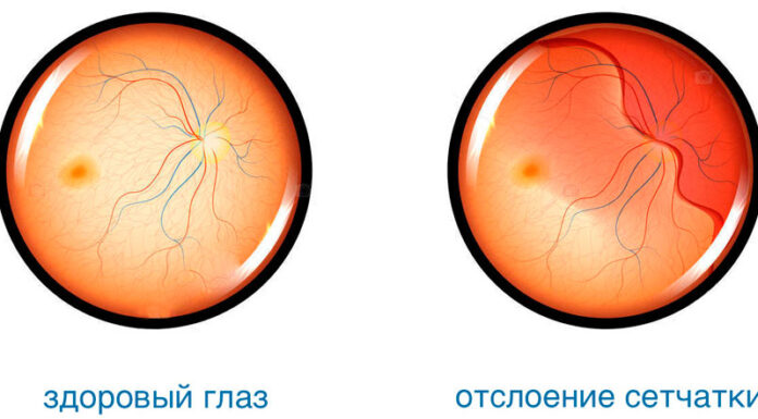 Причины отслоения сетчатки глаза