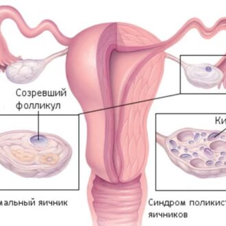 СПКЯ и бесплодие: как лечиться и быстро забеременеть