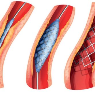 Где сделать коронарное стентирование сосудов?