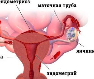 Эндометриоз и бесплодие: можно ли забеременеть и вылечиться