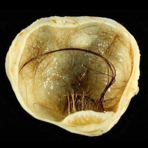 Дермоидная киста яичника и беременность: причины, факторы риска, осложнения