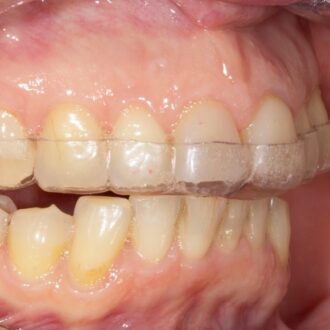 Миорелаксирующая каппа: эффективное решение для снятия мышечного напряжения