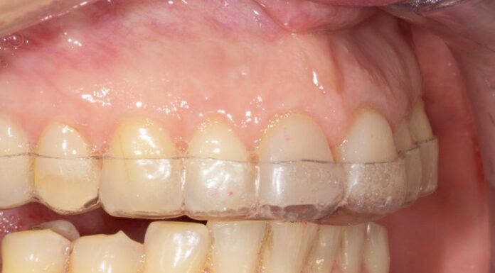 Миорелаксирующая каппа: эффективное решение для снятия мышечного напряжения