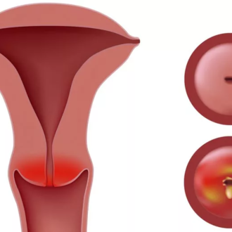 Цервицит: симптомы и лечение