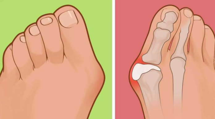 Вальгусная деформация большого пальца стопы: причины появления и симптомы