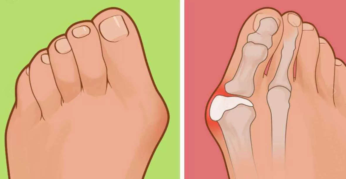 Вальгусная деформация большого пальца стопы: причины появления и симптомы