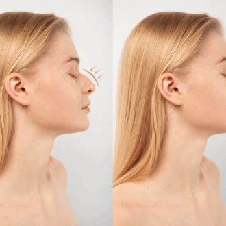 Ринопластика: что это такое, кому показана и каких результатов ожидать