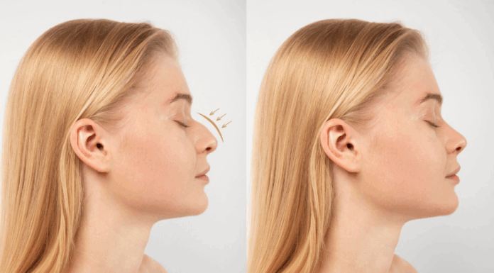 Ринопластика: что это такое, кому показана и каких результатов ожидать