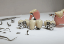 Аттачменты в стоматологии: инженерный подход к фиксации протезов