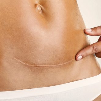 Шов после кесарева сечения. Правильный уход, возможные осложнения