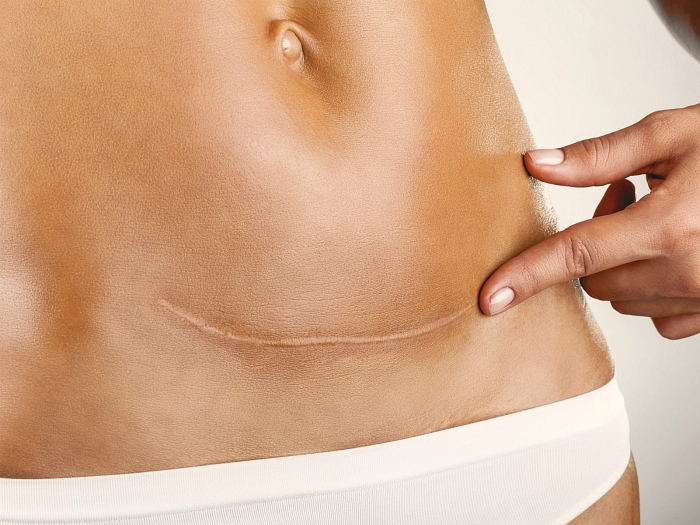 Шов после кесарева сечения. Правильный уход, возможные осложнения