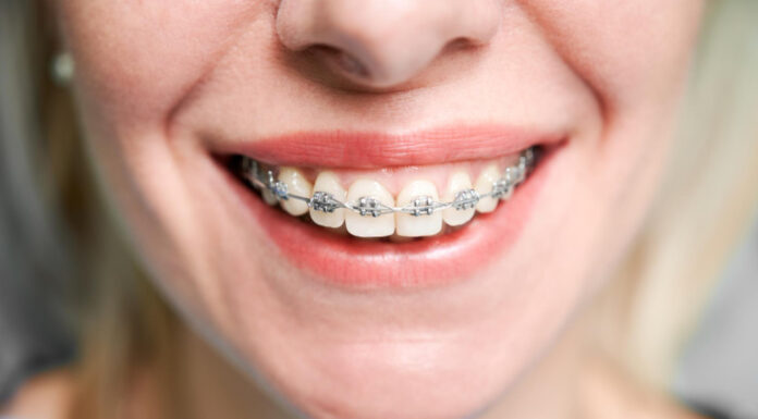 От неровных зубов к сияющей улыбке: история вашего преображения
