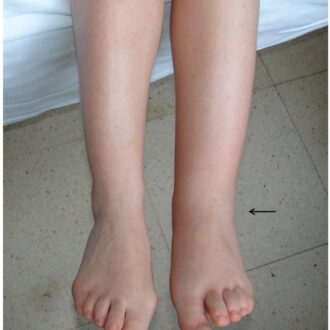 Отеки при заболеваниях ЖКТ