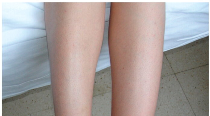 Отеки при заболеваниях ЖКТ