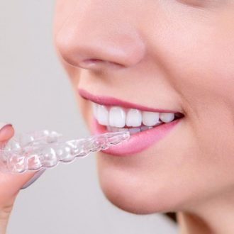 Элайнеры: показания, противопоказания и преимущества