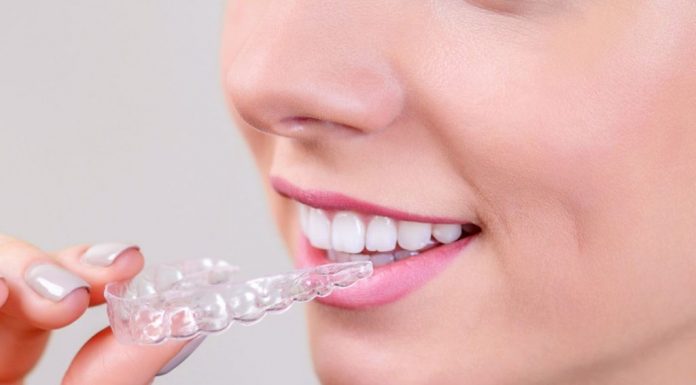 Элайнеры: показания, противопоказания и преимущества