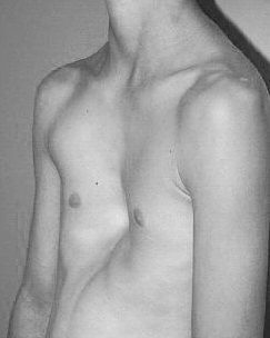 Что такое воронкообразная деформация грудной клетки и как ее лечить