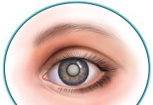 Лечение катаракты