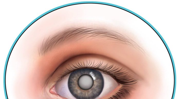 Лечение катаракты