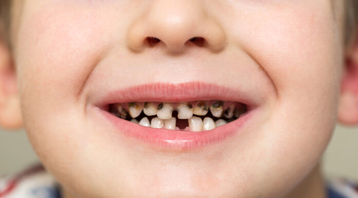 Причины появления гнилых зубов у детей