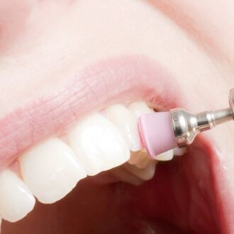 Гигиеническая чистка зубов. Зачем она нужна?