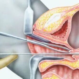 Что такое биопсия эндометрия: виды и как ее делают, что показывает, расшифровка результатов анализов и отзывы
