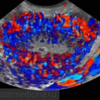 Доплер узи при бесплодии