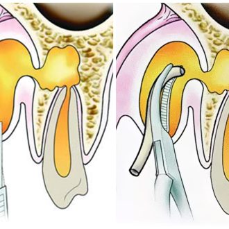 Развитие и способы лечения абсцесса зуба: краткое руководство к действию