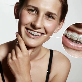 Невидимые брекеты и их преимущества