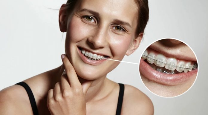 Невидимые брекеты и их преимущества