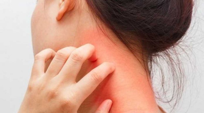 Советы по поддержанию здоровья при атопическом дерматите