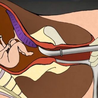 Бесплодие после аборта