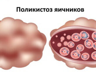 Поликистоз яичников: причины и механизм развития заболевания, первые признаки и клинические симптомы, схема лечения патологии, прогноз на зачатие
