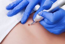 Как происходит удаление новообразований?