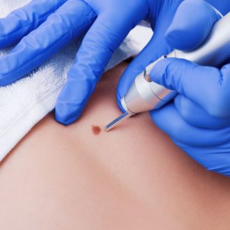 Как происходит удаление новообразований?