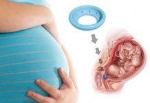 Акушерский пессарий: что это такое и в когда назначают?