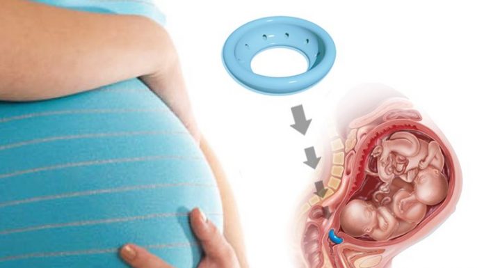 Акушерский пессарий: что это такое и в когда назначают?