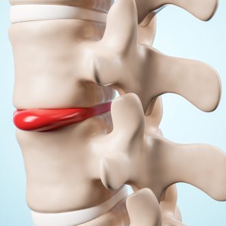 Диагностика межпозвоночных грыж